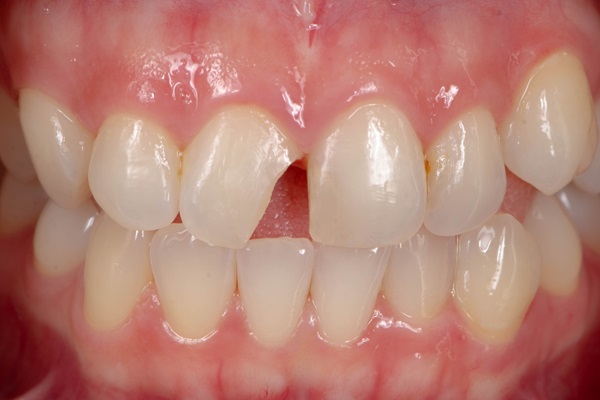 Can A Broken Tooth Lead To Infection?